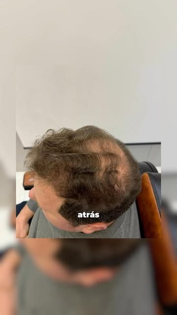 🔥 De Tapejara direto pra transformação!

Esse é o caso do Tiago: calvície grau 5, com rarefação for