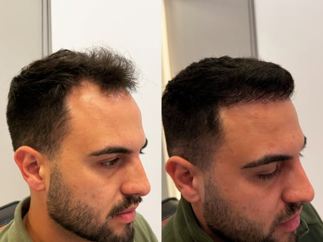 ✨ 5 MESES DE PÓS-OPERATÓRIO — E ISSO É SÓ O COMEÇO! ✨

Olha essa transformação!  Paciente chegou com