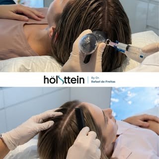 Recibimos muchas consultas de mujeres que se interesan por la mesoterapia capilar en verano.

La épo