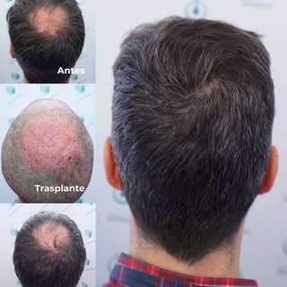 El trasplante capilar en la coronilla requiere algo más que una buena intervención. La evolución del