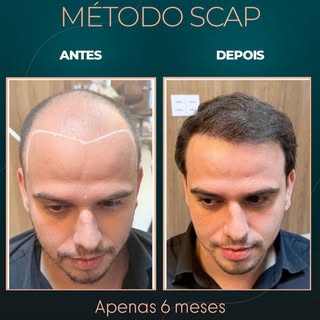 Apenas 6 meses após o transplante capilar e a diferença já é evidente.

Naturalidade, densidade e um
