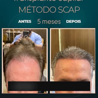 5 meses de transplante capilar… e esse é apenas o começo! 🚀

Os fios já começaram a ganhar densidad