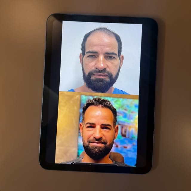 Deixando registrado no nosso feed um resultado que merece destaque: apenas 6 meses de pós-transplant