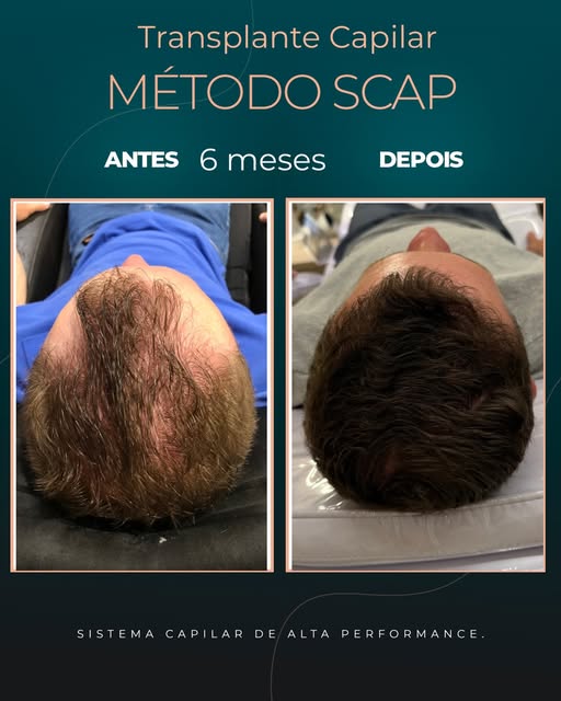 6 meses de pós-transplante capilar.

Aos 6 meses, já conseguimos observar uma evolução importante da