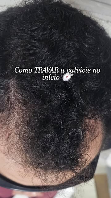 Recuperar a tua moldura do rosto é recuperar a tua autoestima.
​💬 Envia-nos uma mensagem privada pa