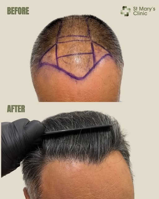 Two stage hair restoration in a 55 year old patient.

A total of 6,500 grafts were transplanted acro