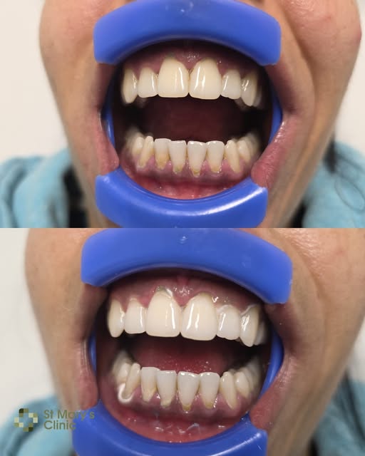 A brighter smile can make a big difference. ✨

Professional teeth whitening is designed to lift stai