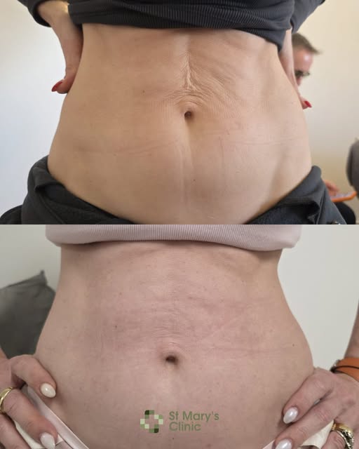 Saggy skin can be stubborn, but there are treatment options available.

By combining Rf Microneedlin