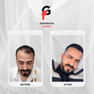 Gaziantep Fue ailesi olarak, sadece saç ekmiyoruz; danışanlarımızın özgüvenini yeniden inşa ediyoruz