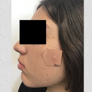 Don’t let warts hold back your confidence! 🌟Warts on the face can be tough, but there are safe and 