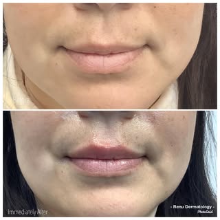 Plump, hydrated lips are in! 💋Our expert lip fillers enhance shape, volume, and definition for a na