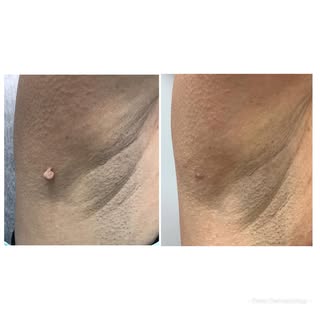Got annoying skin tags? Let our dermatologist expert remove them safely and professionally— with alm