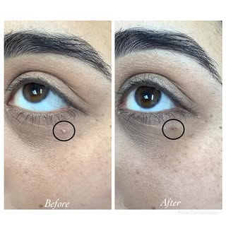📍Do you have irritated, painful, or inflamed skin tags? 
Don’t pick at them- remove them safely wit