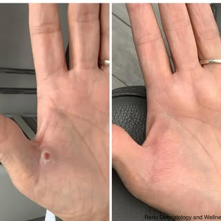 📸Before ➡️ After 
This fast-growing red bump was a pyogenic granuloma— often caused by irritation o