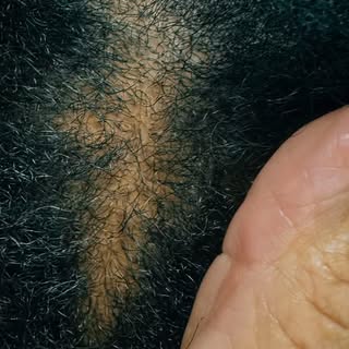 Tomorrow 8:30am est  WINNERS ANNOUNCED.  FREE SCALP CHECKUP.  #trichologist #hairlossspecialist #sca