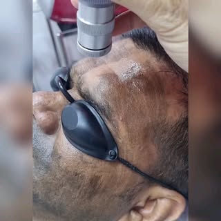#hollywoodpeel #carbonpeel #dermatology #cosmetology #skincare #skinclinic #calicut #laserpeel #evol
