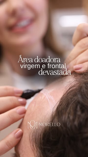 Caso do dia super especial.

Calvície extensa bem concentrada na região frontal, uma das áreas mais 