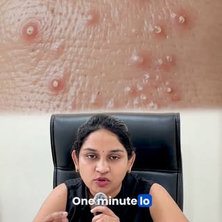 Cheeks meedha, jawline meedha pimples repeat avuthunnaya? ee reel meekosame.

Acne severity mariyu s