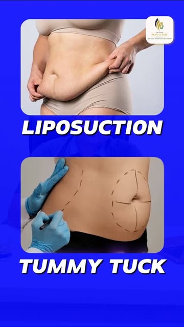 Mee body ki Liposuction VS Tummy Tuck, edi cheskovali??

Mee body condition evaluate chesukoni corre