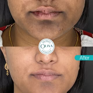Struggling with dark spots, uneven tone and dullness? 

See the results of Oliva’s DeepRenew Laser T