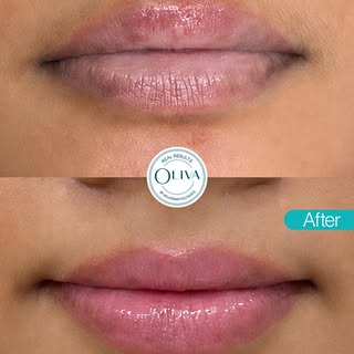 If you’ve been trying to fix the pigmentation on your lips, this one’s for you. 

Oliva’s Laser Toni
