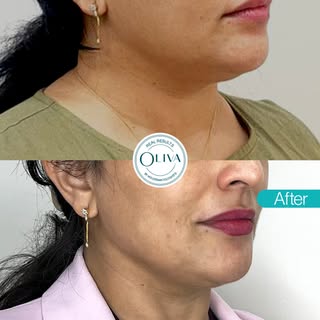 Loss of definition along your jawline and cheeks?

Comment to know which treatment this is.

#OlivaC