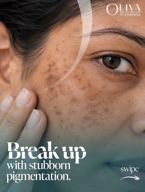 Still compromising with stubborn pigmentation? Consider this your sign to get DeepRenew Laser Toning