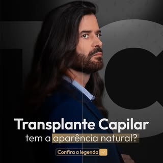 🔍 “O transplante capilar tem aparência natural?” 🔍

Sim! Com técnicas avançadas como FUE e DHI, o 