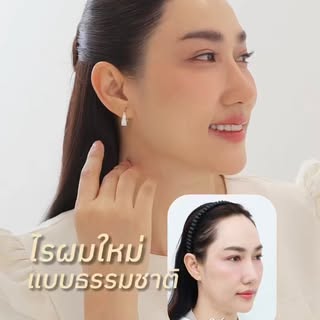 ปลูกผมไปแล้ว.. รู้สึกดีทุกครั้งที่ส่องกระจก 
ทำผมง่ายขึ้น มั่นใจมากกว่าเดิม ลบปมด้อยหน้าผากสูงไปเลย!