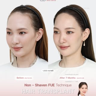 ของจริง ไม่รีทัช! ไรผมสวยเป๊ะทุกมุม! 
ปลูกผมปรับกรอบหน้า เทคนิคไม่โกน #หมอเบสBLS สรรค์สร้าง BLS Hair
