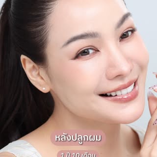 เลือกถูกแล้วที่ทำ! ปลูกผมที่ BLS แฮปปี้มาก ๆ
1 ปี 10 เดือน ไรผมธรรมชาติมาก เนียนแบบคนจับโป๊ะไม่ได้!
