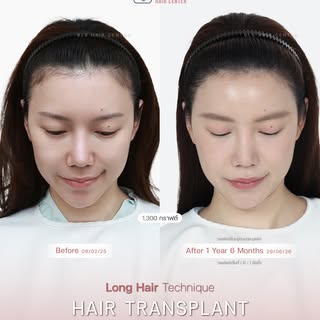 “นี่แหละ กรอบหน้าที่เป็นเรา”
สวย มั่นใจขึ้น ในแบบที่ยังเป็นตัวเอง BLS Hairline เป๊ะ แบบไม่โป๊ะ
กลบปั