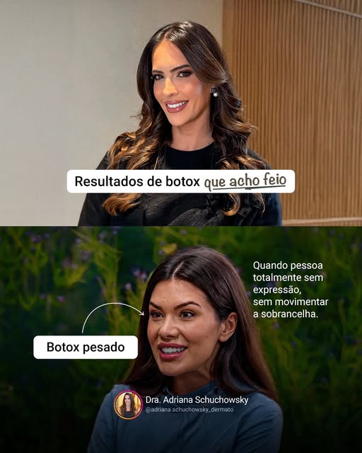 A toxina botulínica é excelente quando bem indicada, bem dosada e aplicada respeitando a anatomia e 