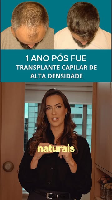 Transplante capilar não é simplesmente colocar fios onde existe uma área de calvície.

Tudo começa a
