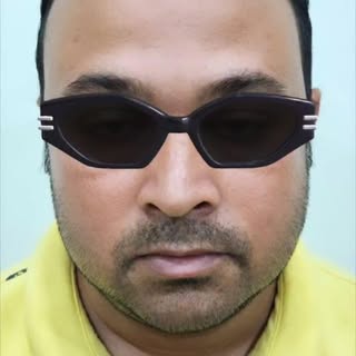 After 6 months 😃
#hair #hairtransformation #hairtransplant #hairtransplantsurgery #hairtransplantbh