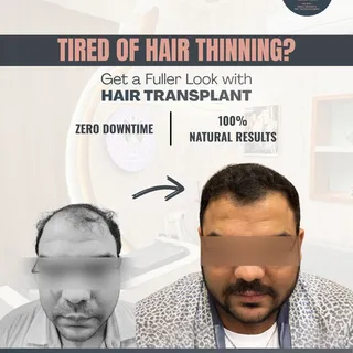 Hairline going back faster than your motivation? 👀
Let’s fix that.

✔ 100% Natural Results
✔ Zero D