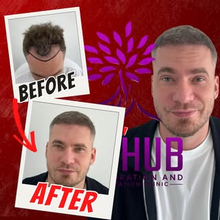 Some things don’t need a long caption.

The results speak for themselves. Questions?

#hairtransplan