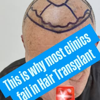 Most hair transplants fail for one reason:

Poor planning.

Natural density.
Correct angulation.
Pro