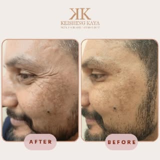 ✨ Timeless beauty begins with the details.

Smooth, youthful appearance with precision wrinkle corre