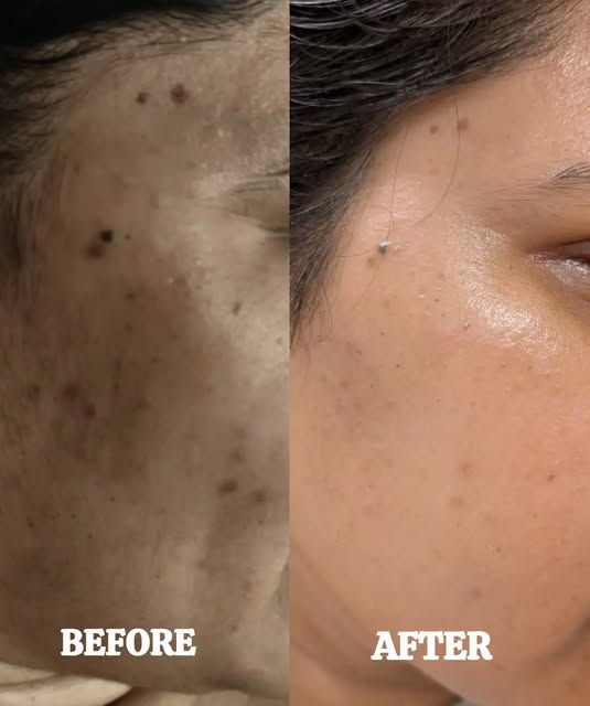 Visible transformation, healthier skin, brighter skin and renewed confidence! ✨

 After customized s