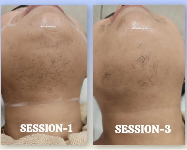 ✨ Visible results, smoother skin! ✨

Just by the 3rd session, there is a remarkable reduction in hai