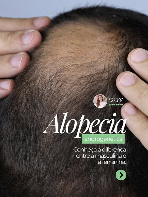A alopecia androgenética pode se manifestar de formas diferentes em homens e mulheres. Identificar o