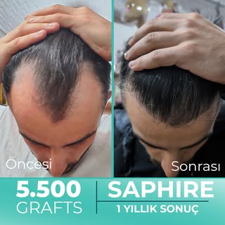 Hastamız Emirhan Bey'e tek seansta 5.800 Greft safir FUE saç ekimi gerçekleştirdik. Hastamızın 1 yıl