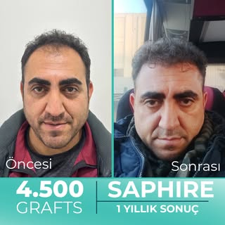 Hastamız Barış Bey'e tek seansta 4.500 Greft safir FUE saç ekimi gerçekleştirdik. Hastamızın 1 yıllı