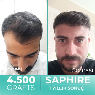 Hastamız Ömer Bey'e tek seansta 4.500 Greft safir FUE saç ekimi gerçekleştirdik. Hastamızın 1 yıllık