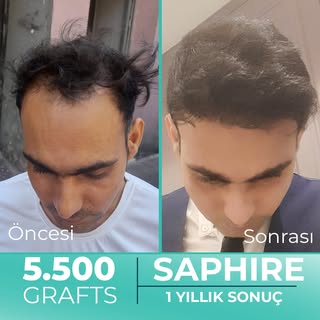 Hastamız Murtaza Bey'e tek seansta 5.500 Greft safir FUE saç ekimi gerçekleştirdik. Hastamızın 1 yıl