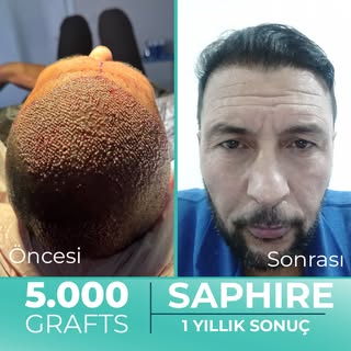 Hastamız Yusuf Bey'e @yusuf403x tek seansta 5.000 Greft safir FUE saç ekimi gerçekleştirdik. Hastamı