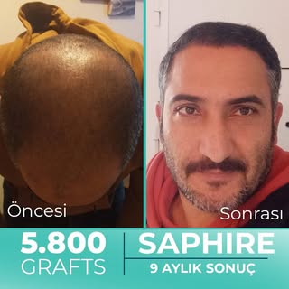 Hastamız Engin Bey’e, tek seansta 5.800 greft ekim yaptık. Hastamızın 9 aylık sonucu👌

@carlaistanb