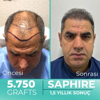 2 Seans Safir FUE Saç ekimi planladığımız Hastamız Zeki Bey'e, ilk seansta 5.750 greft ekim yaptık. 