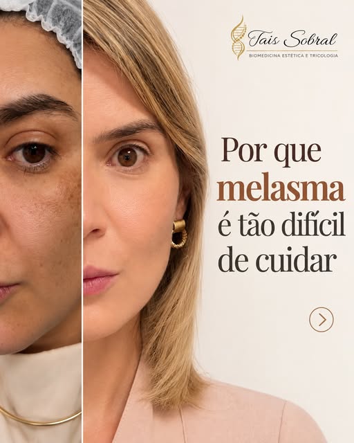 O melasma não é apenas uma mancha no espelho: ele altera o contraste natural do rosto e passa uma se